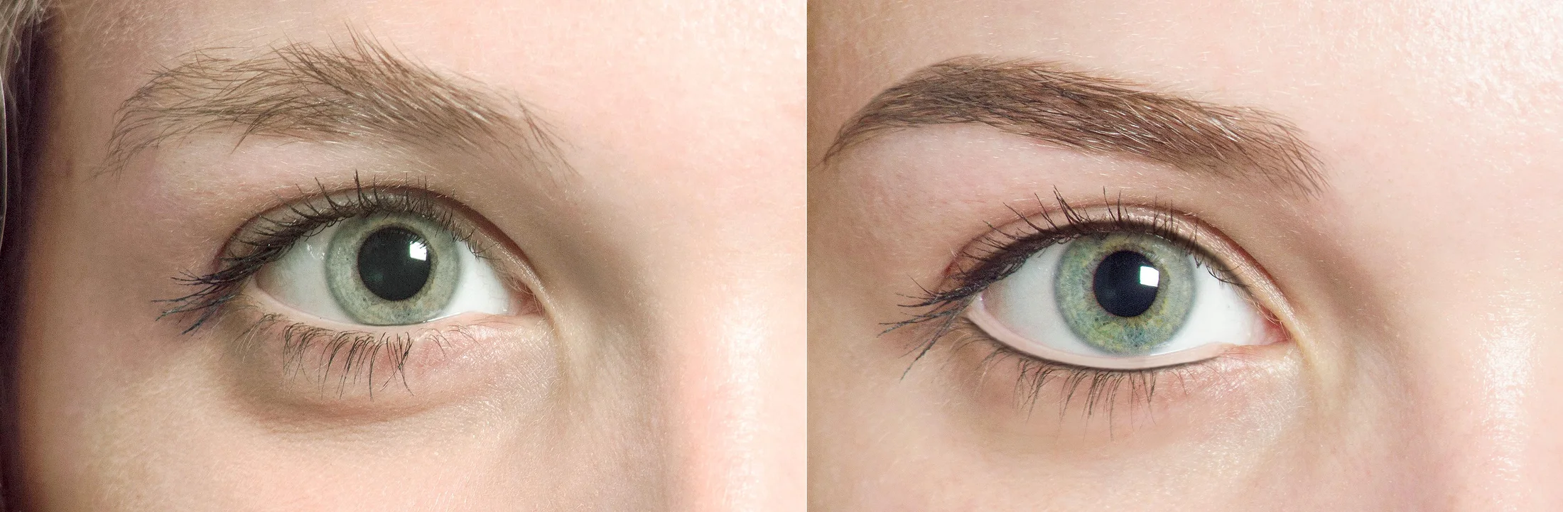 Feine Wimpernkranzverdichtung